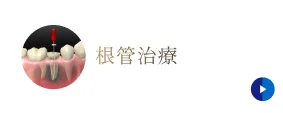 根管治療